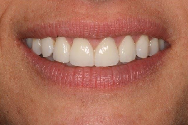 veneers after image