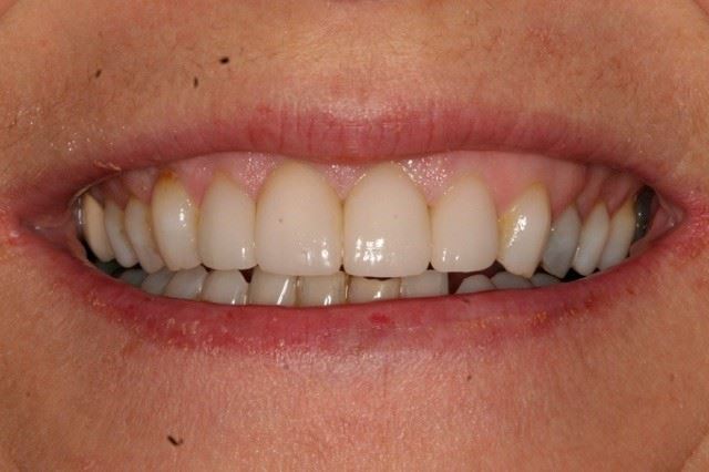 veneers after image